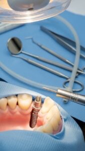 Dental Implants