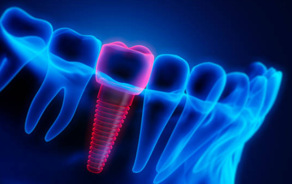 dental implants