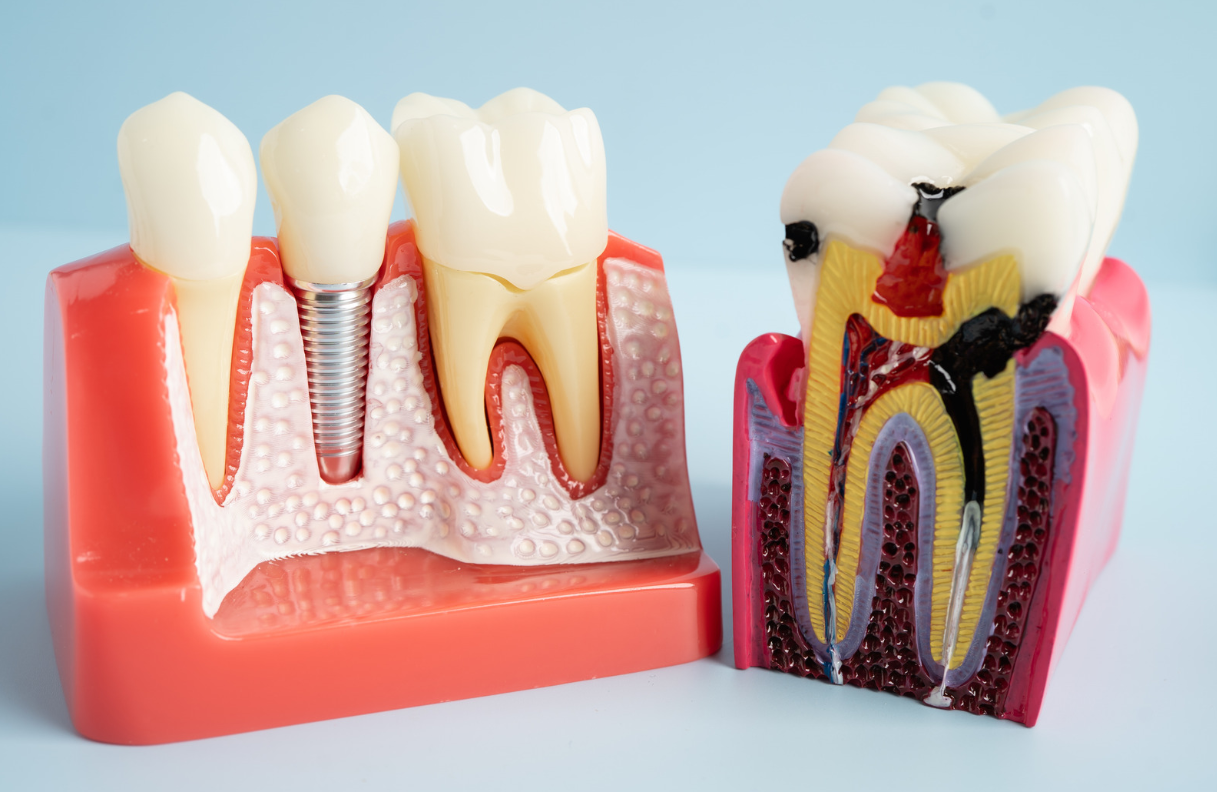 Why Does a Tooth Hurt So Much Before a Root Canal?