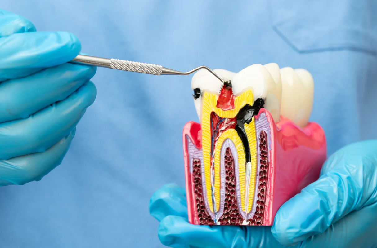 What Is the Price for Root Canal Treatment in Clearwater?