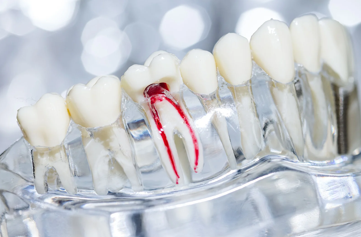 What Material Is Used for Root Canal Treatment?